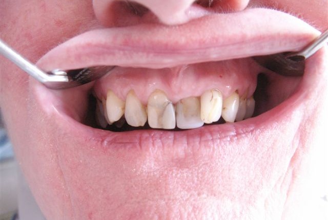 Verschachtelung der Zähne und alte insuffiziente Kunststoffrestauration.